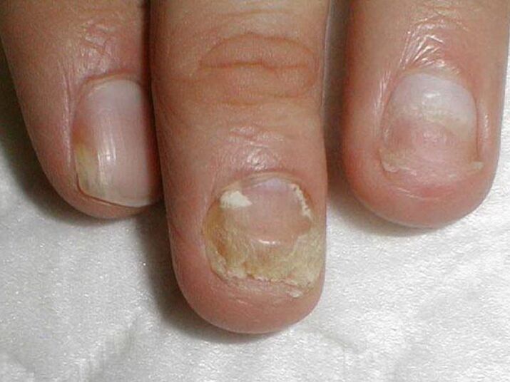 trattamento fungo delle unghie candida