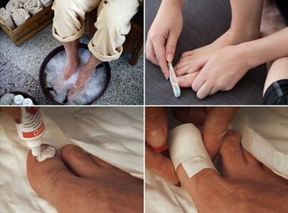 Piedi fumanti e applicazione di crema all'urea sulle unghie colpite da funghi