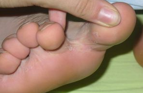 Il fungo tra le dita dei piedi