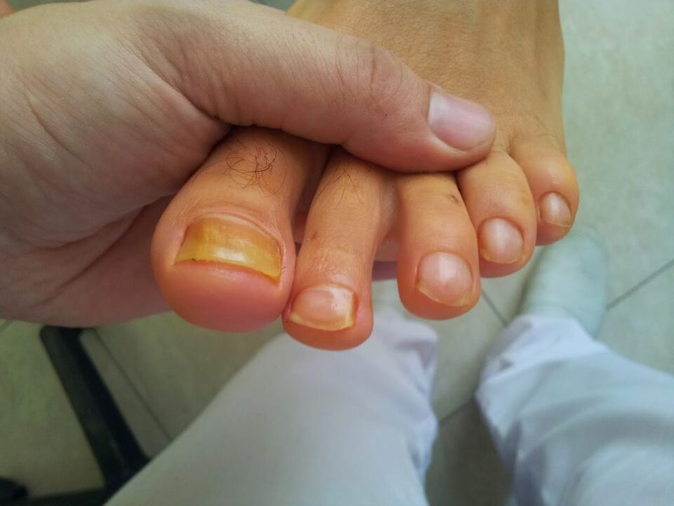 ingiallimento delle unghie dei piedi con funghi
