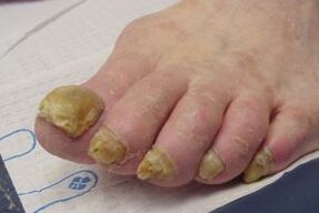 sintomi del fungo dell'unghia del piede