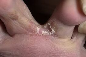 fungo della pelle tra le dita dei piedi