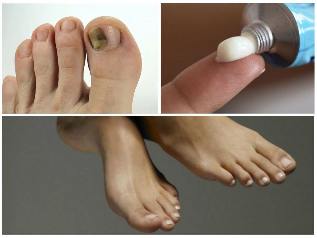 nail fungo sui piedi di trattamento