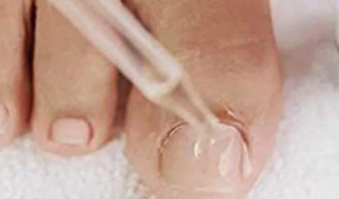 Gocce da funghi delle unghie dei piedi