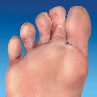 fungo della pelle del piede