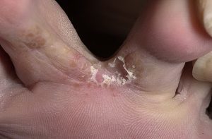 forma di fungo del piede